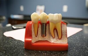 بهترین متخصص ایمپلنت دندان کیست و چه ویژگی هایی دارد؟