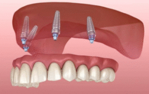 دندان مصنوعی بر پایه ایمپلنت راه حل بی دندانی