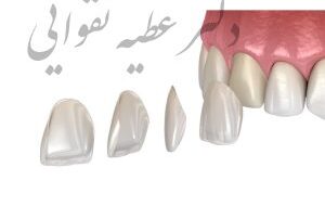 کدام روش اصلاح طرح لبخند مناسب است؟ لمینت دندان یا کامپوزیت دندان